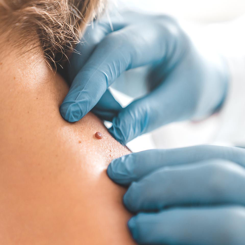 Uuwanie kurzajek Warszawa