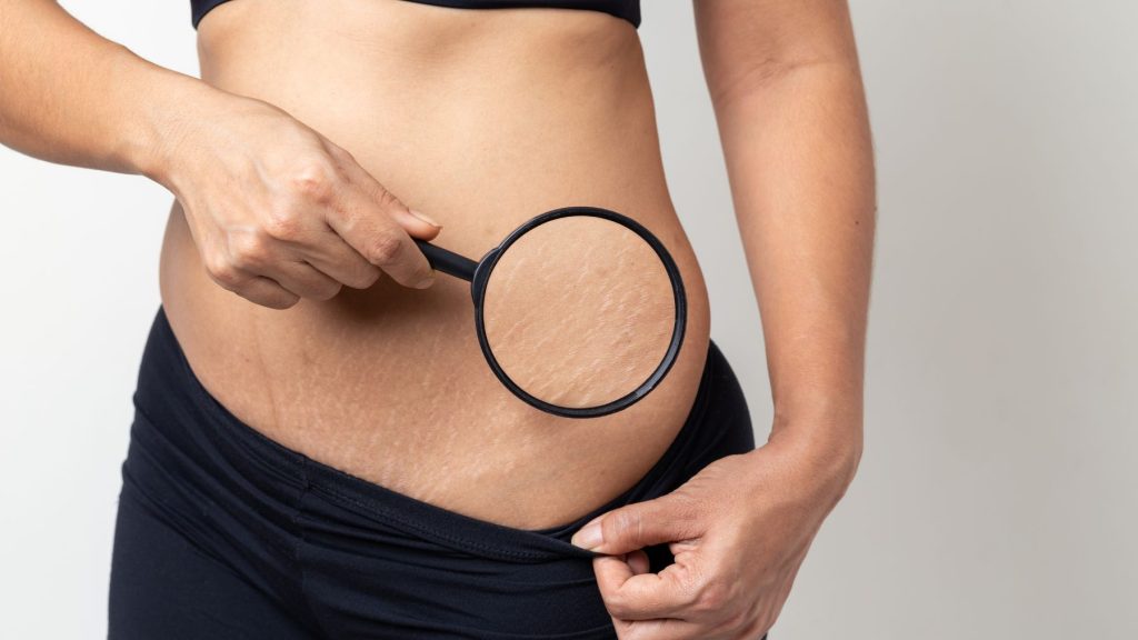 usuwanie rozstępów warszawa